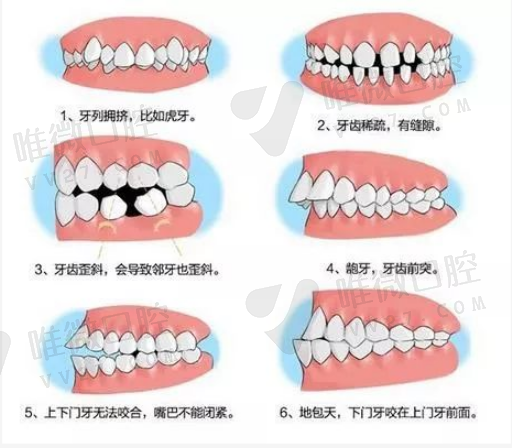 种植牙的优点是什么（种植牙有缺点讲解）(图1)